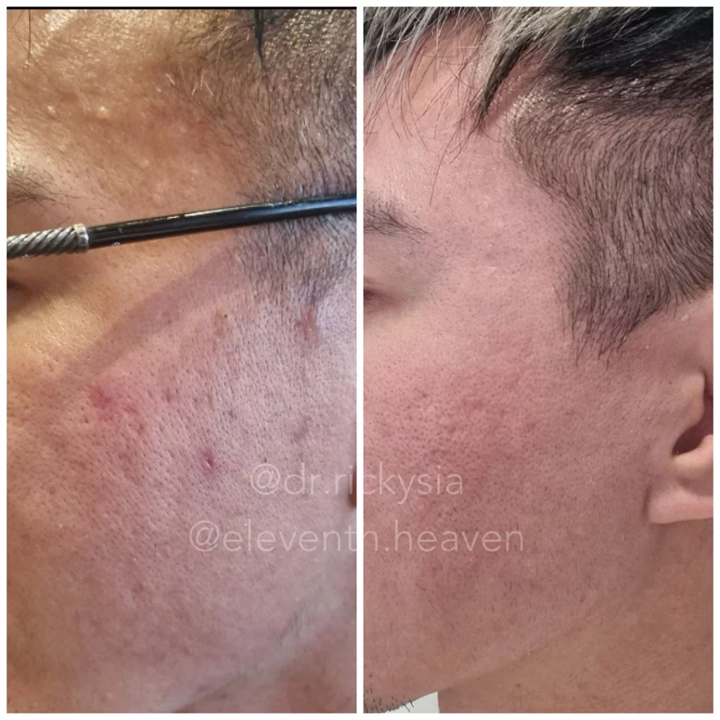 before and after bbl treatment | Eleventh Heaven™ brisbane before and after bbl treatment