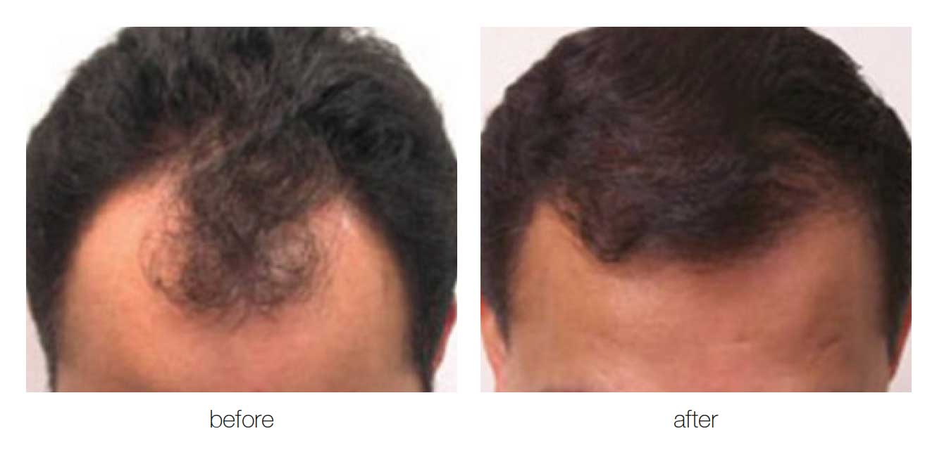 NeoGraft Brisbane Before and After photo male baldness | Eleventh Heaven NeoGraft Brisbane Before and After photo male baldness