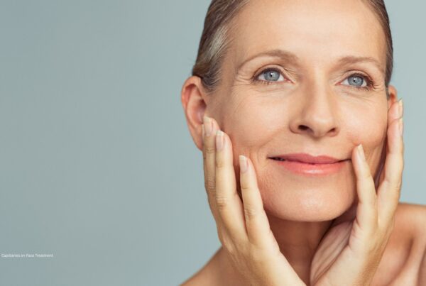 Broken Capillaries on Face Treatment BBL Hero Laser Clinics | Eleventh Heaven™ Broken Capillaries on Face Treatment BBL Hero Laser Clinics